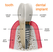 Implant2